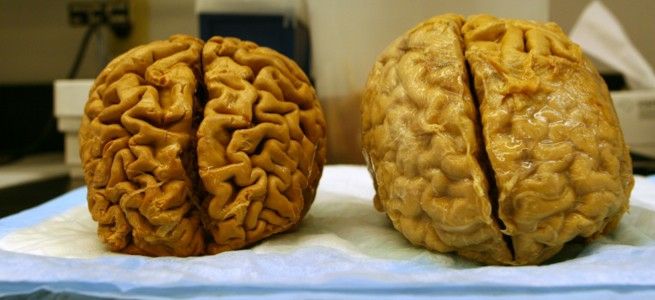 અલ્ઝાઇમર, ડ્રગ, દવા, રોગ, મોત