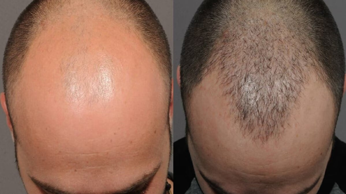 ચમત્કારિક શિબિર, ટાલ પડવાની સારવાર, વાળ ઉગાડવાની દવા, પંજાબના સંગરુર, આંખોમાં બળતરા, હાનિકારક કેમિકલ