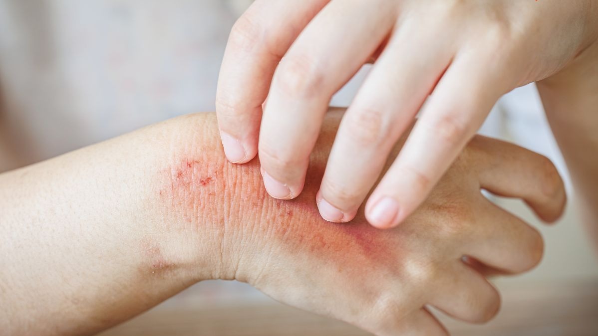 ચોમાસું,  ત્વચાની કાળજી,  સ્કિન ઇન્ફેક્શન,  ફંગલ ઇન્ફેક્શન,  બેક્ટેરિયલ ચેપ,  સ્કિન ટિપ્સ,  હેલ્ધી સ્કિન,  મોનસૂન સ્કિન કેર,  ઘરગથ્થુ ઉપાયો