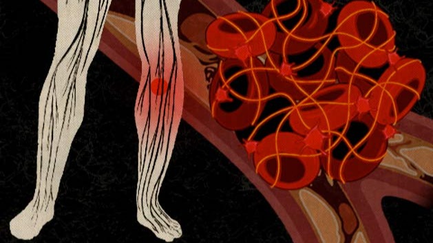 લોહી ,  થેલેસિમિયા, પોલીસાયથેમિયા વેરા, ઓટોઈમ્યુંન હિમોલિટિક એનીમિયા, એપ્લાસ્ટિક એનીમિયા