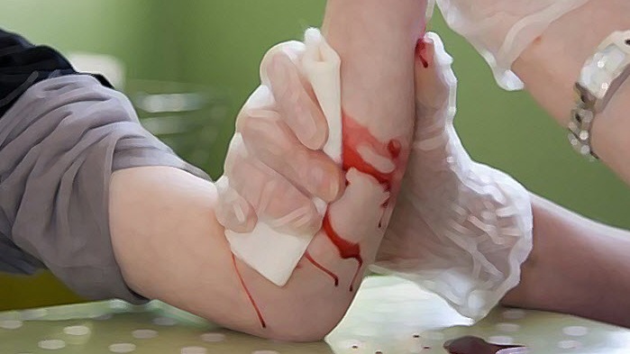 ફાઇબ્રીનોજન, ઇન્જેકશન, હાઇપોફિનોજનમિયા, દર્દી,  ગ્લાસ,  સ્લાઇડ,  ટેફલોન ફિલ્મ